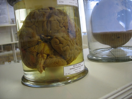 Test Tube Brain Grown to Battle Alzheimer's [Slideshow]